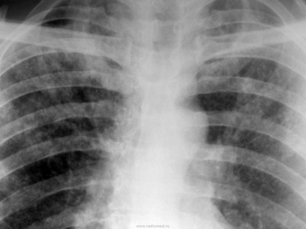 Видно ли туберкулез на снимке рентгена? туберкулез, является, затемнения, наличие, исследование, патологии, легких, снимке, развития, органа, рентгене, можно, туберкулеза, составляет, патологического, которые, несколько, проходить, очагов, всего