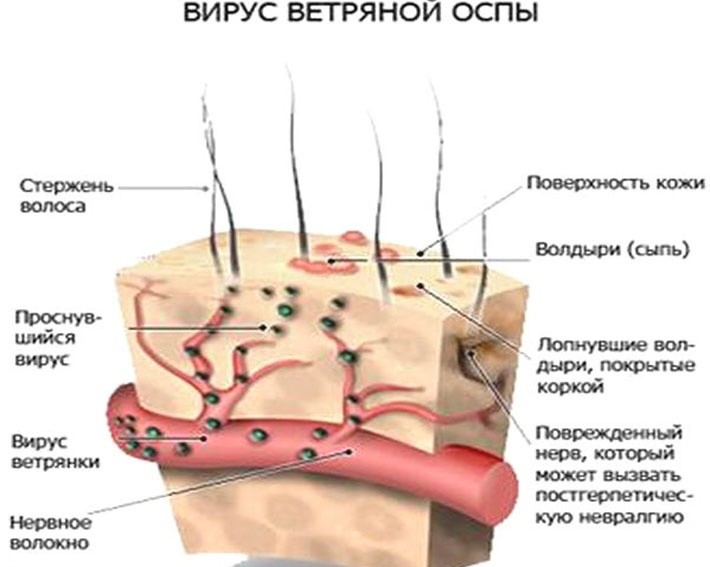 Детские заболевания, которые плохо переносят взрослые