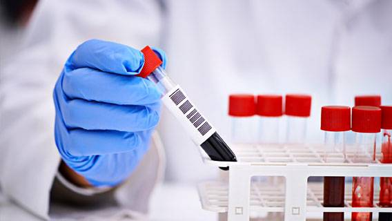 Первый тест на анализ крови для диагностики болезни Альцгеймера поступил в продажу в США