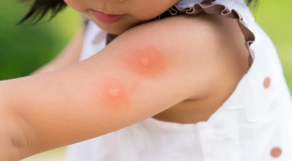 Не только клещи: 9 укусов насекомых, после которых стоит показаться врачу медицина и здоровье,укусы насекомых
