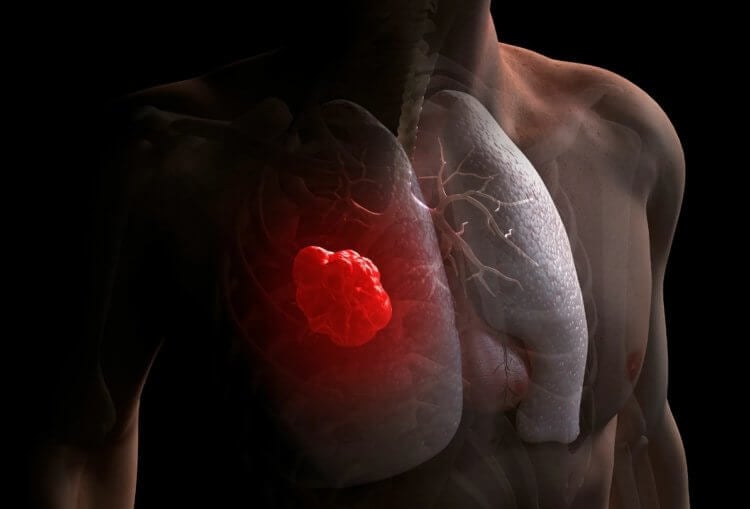 Каким бывает рак сердца — смертельная болезнь, о которой почти никто не говорит сердца, может, опухоль, очень, потому, опухоли, всего, сердце, другие, случае, любом, заболевание, которая, этого, начальной, считают, существует, диагноз, метастазы, такой