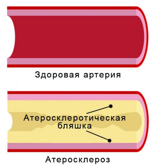 Боли в области икры. Возникают боли в ногах при ходьбе 01