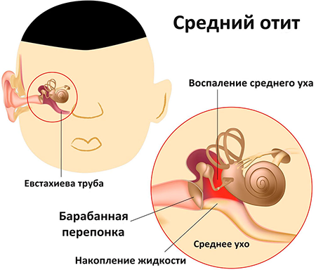 Отит и травмы уха — чем может закончиться летнее купание и что делать, чтобы избежать неприятностей болезни уха,здоровье и медицина