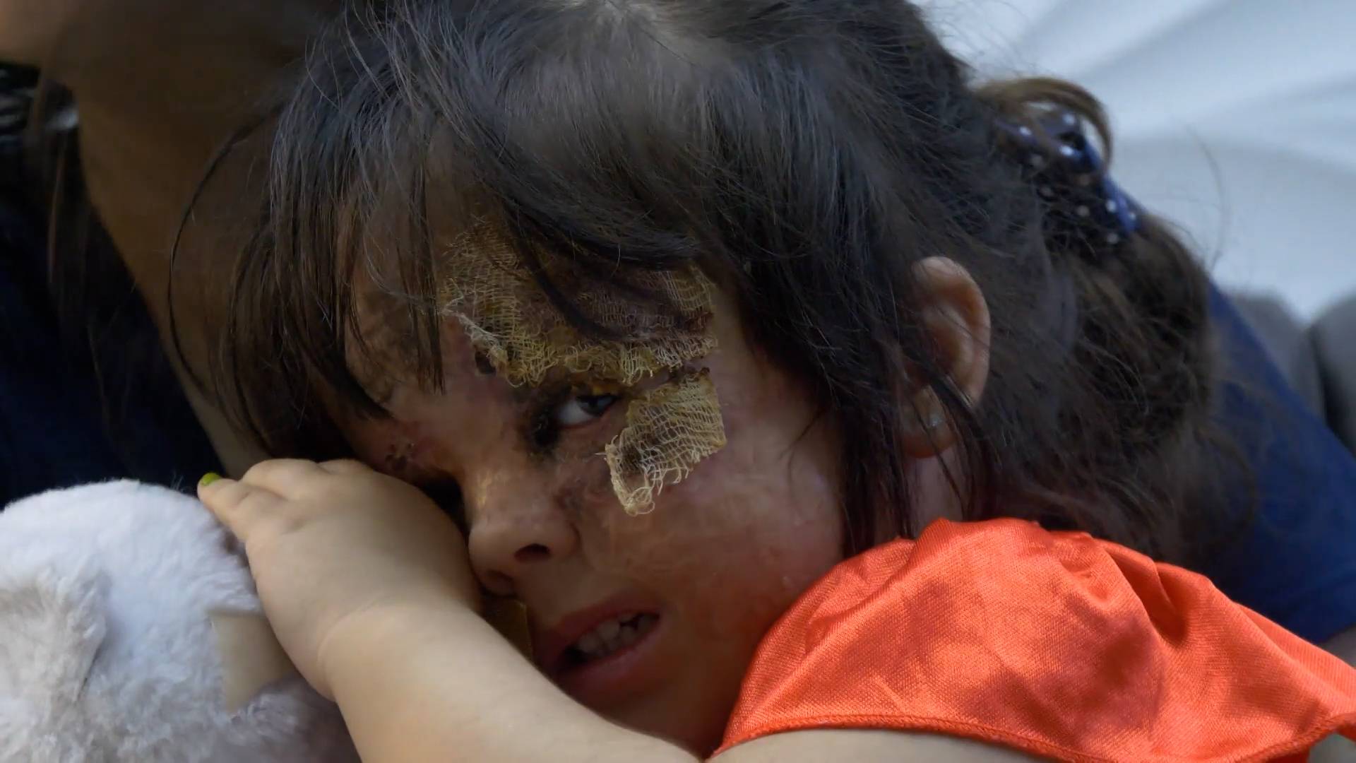 Краснодарский хирург удалил опасное пятно с лица американской девочки