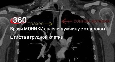 Врачи МОНИКИ спасли мужчину с отломком штифта в грудной клетке