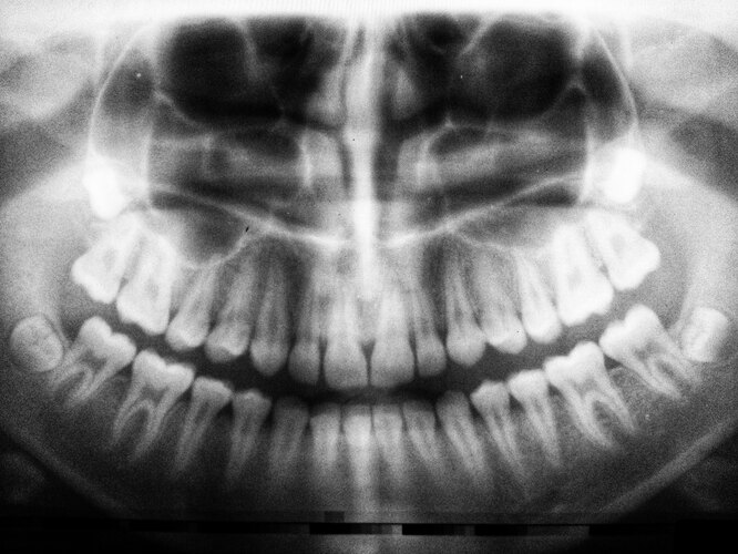 Они могут исчезнуть: 7 неожиданных фактов о зубах мудрости биология,наука,уход за зубами