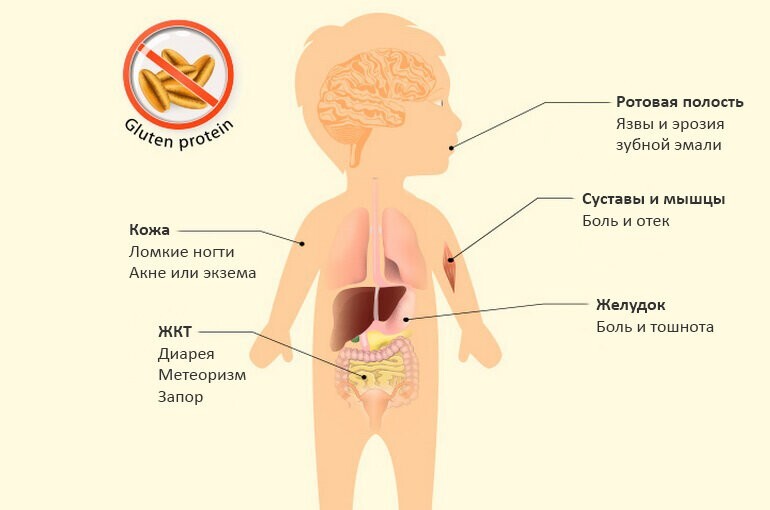 13 неочевидных признаков того, что у вас или ребёнка непереносимость глютена, которые важно знать глютена, людей, может, непереносимостью, часто, могут, Исследования, также, непереносимости, глютеновой, глютеном, глютен, чувствительностью, дерматит, непереносимость, целиакией, такие, симптомы, кишечника, связано
