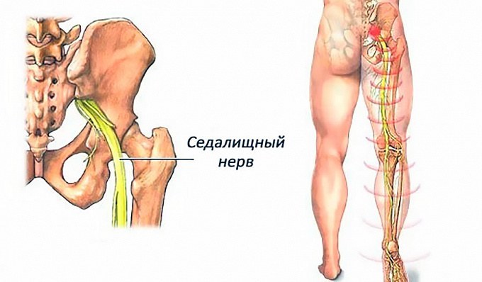 Защемление седалищного нерва: снимем боль за 1 минуту  боль,здоровье, ишиас, поясница,седалищный нерв, упражнения