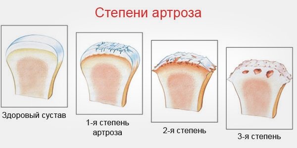 СÑадии аÑÑÑоза