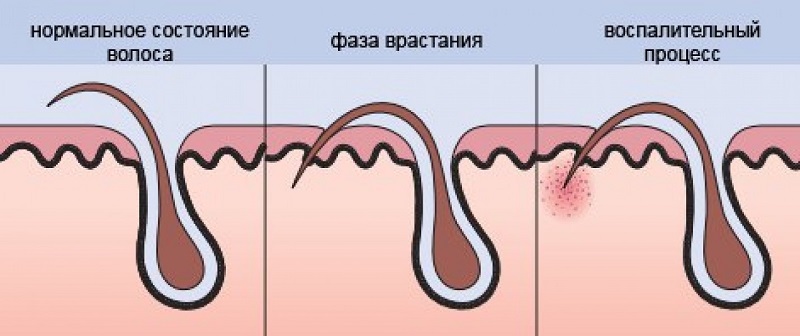 как избавиться от вросших волосков