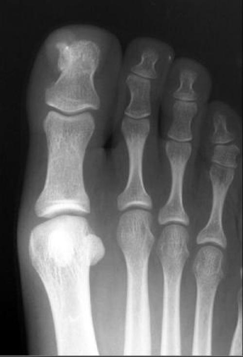 Ногтевая фаланга стопы. Остеохондрома фаланги пальца рентген. Экзостоз фаланги стопы.