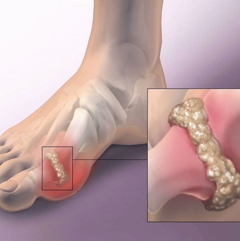 Как вывести мочевую кислоту из организма здоровье, мочевая кислота, суставы