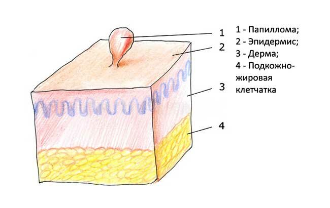 Что будет, если оторвать папиллому?