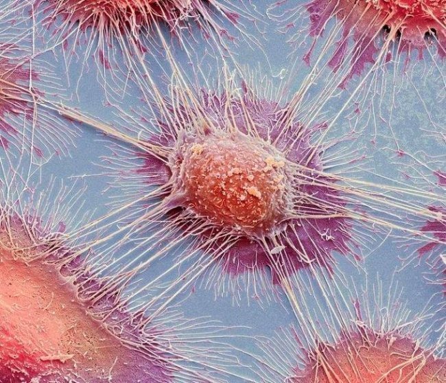 Раковая клетка под микроскопом необычное, прикол, фото
