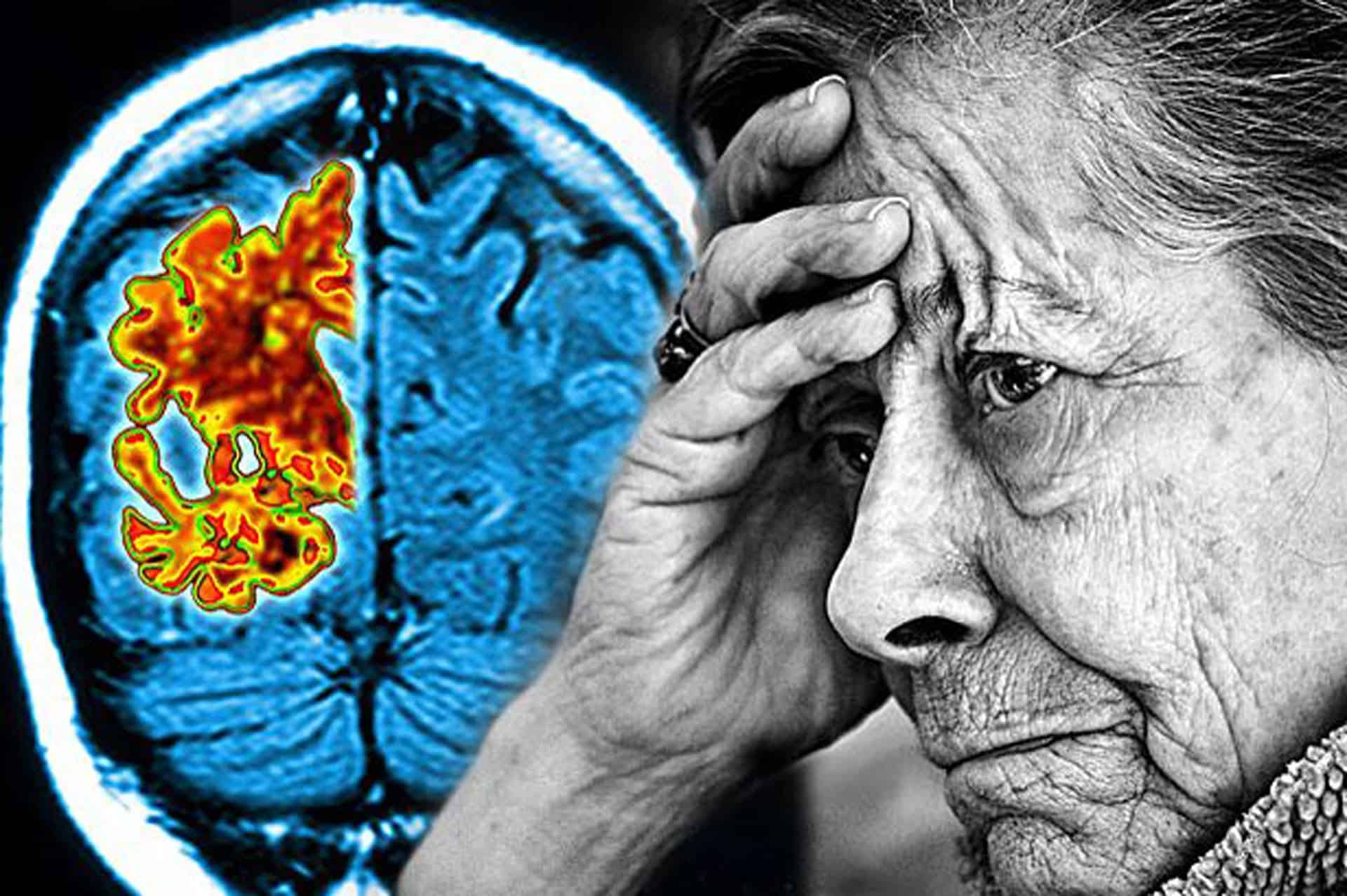 Возрастная деменция. Хвороба Альцгеймера. Энн Вудс болезнь Альцгеймера. Деменция и Альцгеймер. Старческое слабоумие.