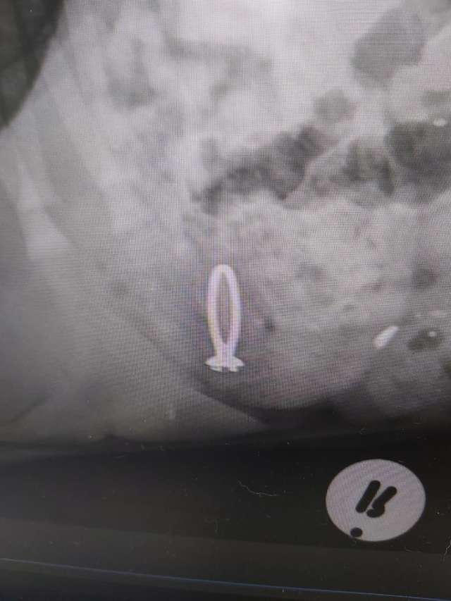 кольцо в желудке