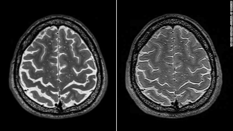Состояние мозга до и после длительной миссии / ©NEJM