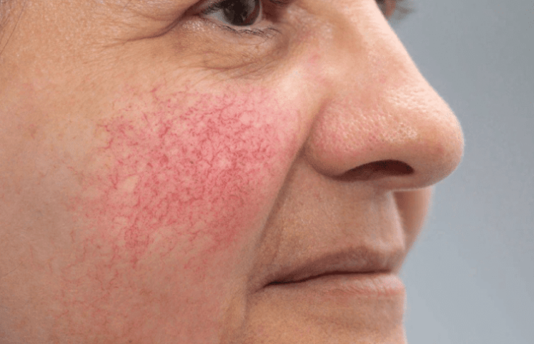 Не всегда розовый румянец означает здоровье. Бывает, что это симптом довольно серьезного заболевания кожи: розацеа или купероз. Купероз и розацеа: что это и в чем разница?-2