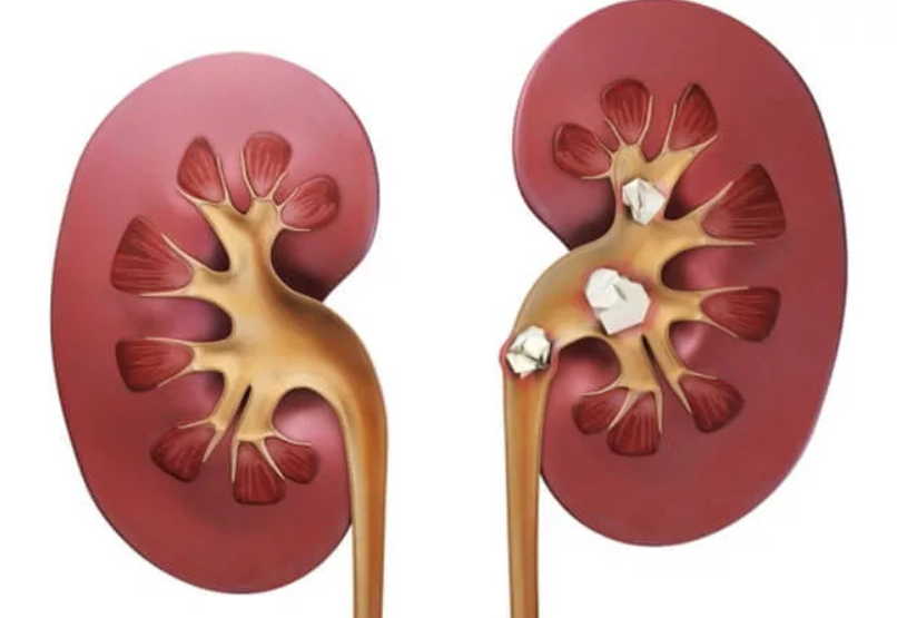 Как изгнать камень из почки лекарствами и травами