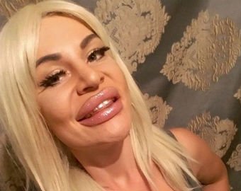 Жертва пластики продемонстрировала "блуждающие" ягодицы