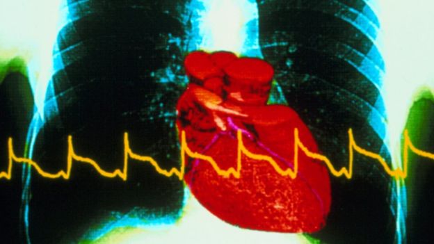 Как распознать "тихий инфаркт"? И можно ли его вообще не заметить? здоровье,медицина,сердечные заболевания