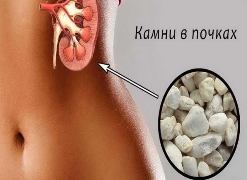 Как изгнать камень из почки лекарствами и травами