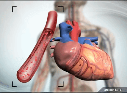 Как происходит инфаркт у человека