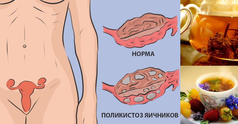 Натуральное средство для лечения поликистоза яичников: никаких гормонов.