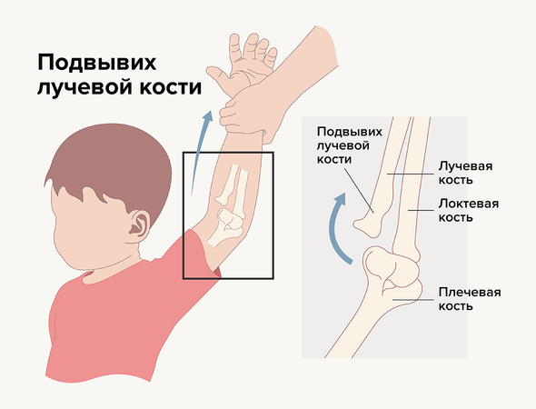 Самая популярная травма у детей от года до пяти, или Почему ребёнка нельзя дёргать за руку дети,здоровье,травмы