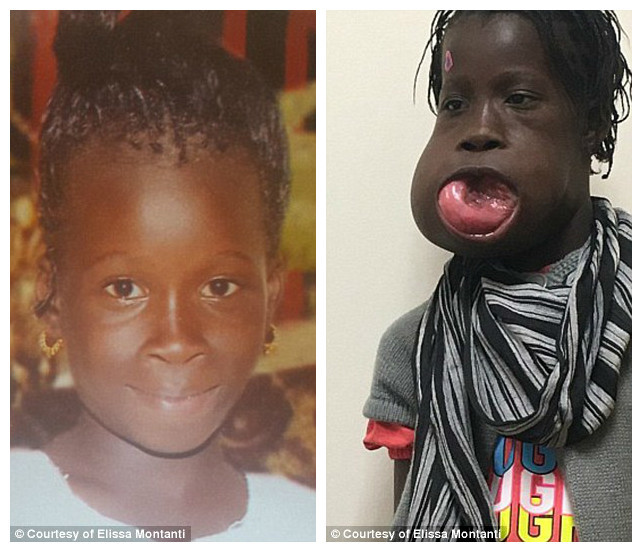 Впервые девочка пожаловалась на боль, когда ей было девять. Мама обращалась к врачам в Гамбии и Сенегале, но безрезультатно врачи, операция, опухоль