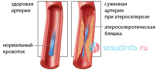 Картинки по запросу блокировка артерий