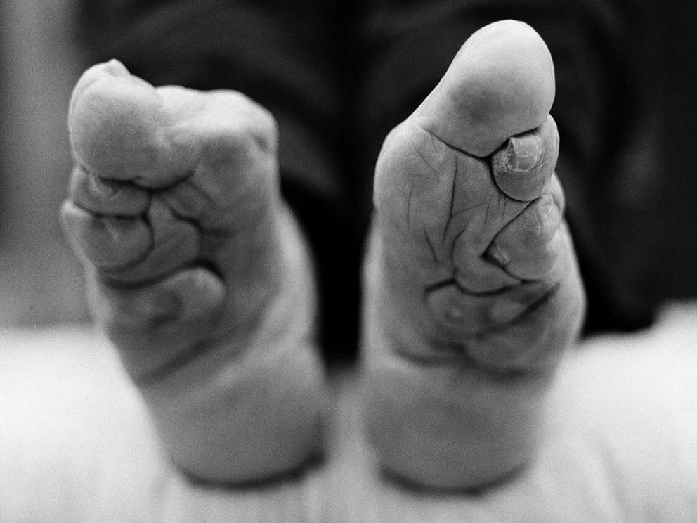 Маленькая стопа
Китай
На протяжении почти тысячи лет маленькие девочки Китая подвергались ужасной процедуре бинтования стоп. Рост стопы останавливался, пальцы скручивались и высыхали, создавая иллюзию миниатюрных и более привлекательных ног.