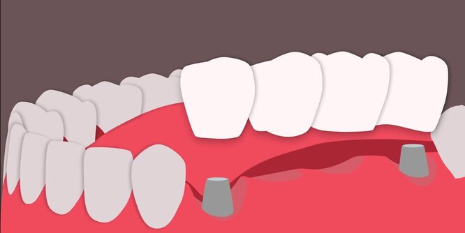 Чем грозит отсутствие зуба, и почему «мосты» и протезы не спасают от деформации челюсти здоровье,медицина,стоматология,уход за зубами