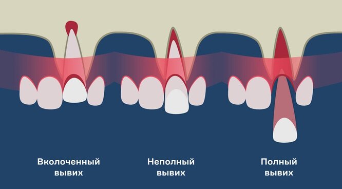 Чем грозит отсутствие зуба, и почему «мосты» и протезы не спасают от деформации челюсти здоровье,медицина,стоматология,уход за зубами