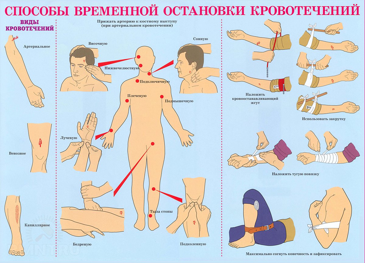 Способы временной остановки кровотечения