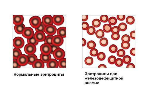 Эритроциты в крови повышены: причины, симптомы, лечение анализ крови,здоровье,медицина,эритроциты