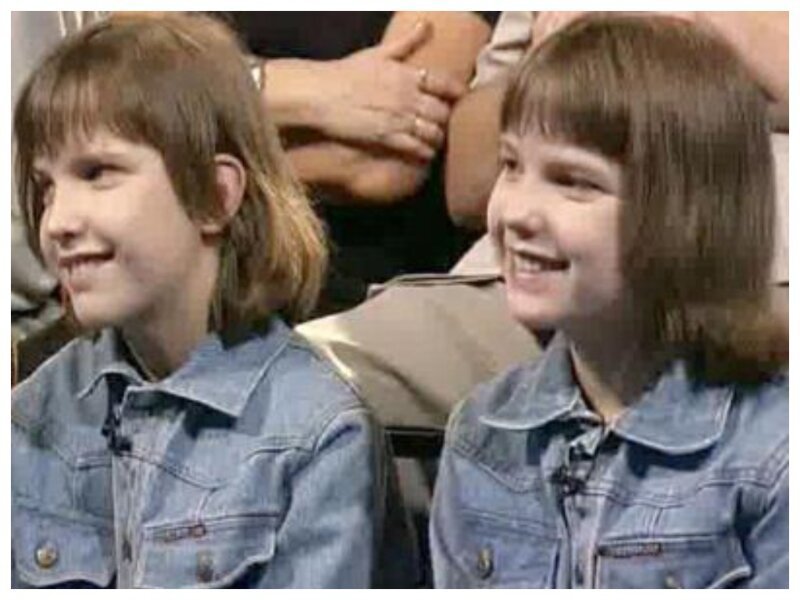 Первые удачно разделенные в СССР сиамские близнецы Аня и Таня Коркины: как они выглядят сейчас 