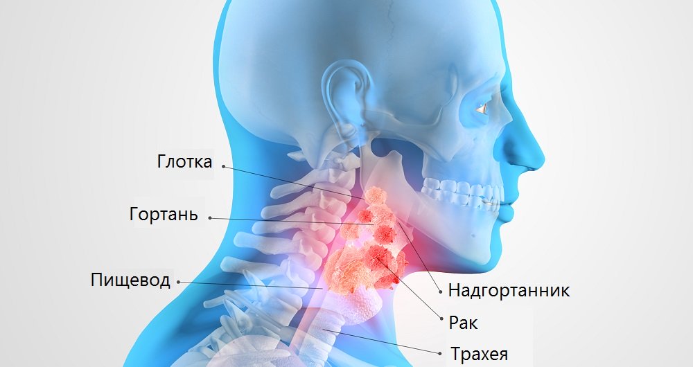 Рак горла - симптомы, причины, стадии и лечение