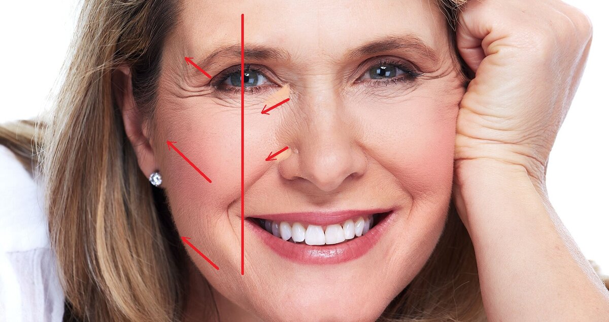 Как визуально сгладить возрастное опущение мягких тканей лица