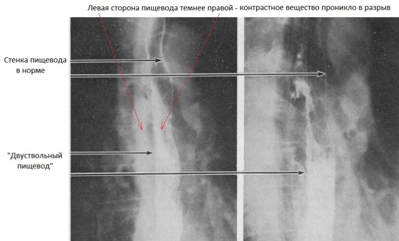 Когда чихаешь сердце останавливается. Разрыв пищевода рентген. Разрыв пищевода рентген контрастное. Спонтанный разрыв пищевода. Повреждение пищевода рентген.