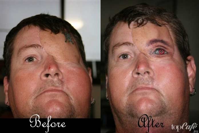 Список опасных пауков: Последствия укуса белохвостого паука