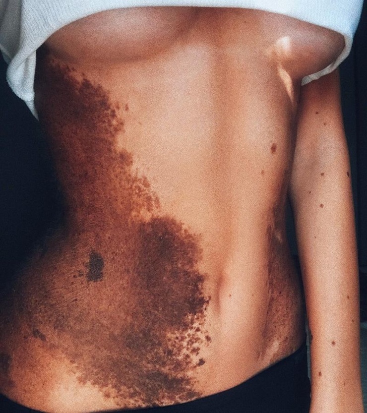 Девушка с огромной родинкой показалась в нижнем белье, и ее осыпали комплиментами Девушка с огромной родинкой показалась в нижнем белье, и ее осыпали комплиментами