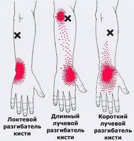 Карта точек боли в теле и точек напряжения мышц (триггеры)