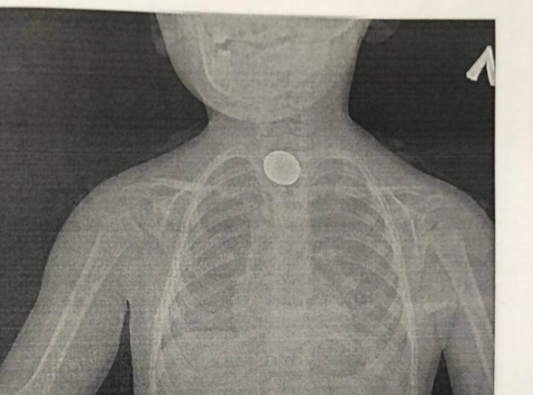 В Новороссийске врачи спасли трехлетнего ребенка: проглотил двухрублевую монету