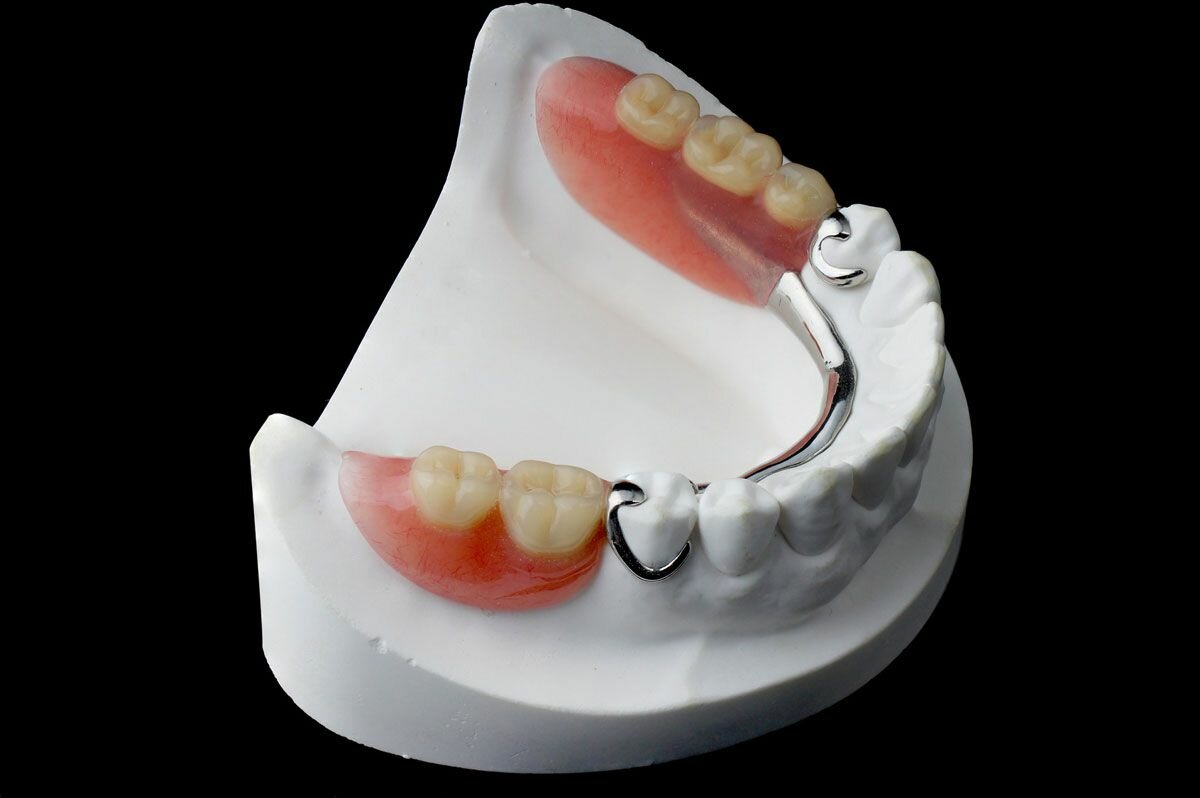 Типичный бюгельный протез, который спроектирован так, что вся нагрузка от отсутствующих зубов падает на одиночный опорный зуб, вывихивая его. 