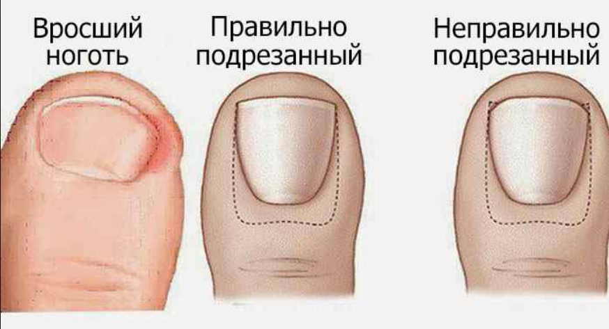 Домашнее лечение вросшего ногтя - народными методами можно быстро справиться с проблемой