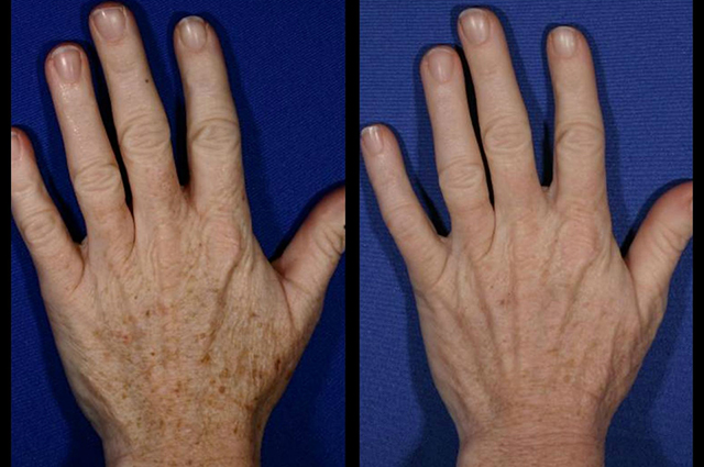 Инъекции, лазеры, пилинги: как ухаживать за руками зимой Инъекции, лазеры, пилинги: как ухаживать за руками зимой новости красоты