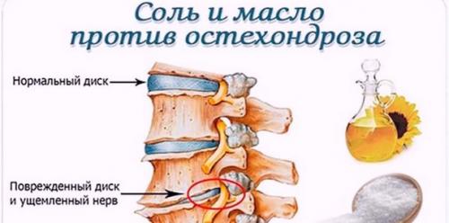 Соль и масло против остеохондроза!