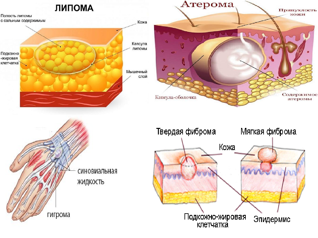 Липомы, атеромы, гигромы и фибромы кожи – что это такое? может, новообразования, содержимое, наследственность, доброкачественные, причины, Выглядит, воспаление, травмы, опухоль, часто, части, помощью, могут, сальной, железы, выдавить, более, удалить, загноиться