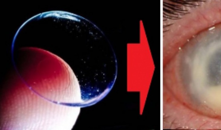 Плохо видно в линзах. Ночные линзы под микроскопом. Глаза человека который уснул в линзах. Глаза при ношении контактных линз.